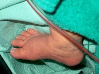 January 19, 2003 - My right foot